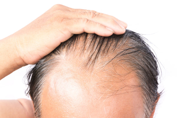 Is there a cure for permanent hair loss in men? 