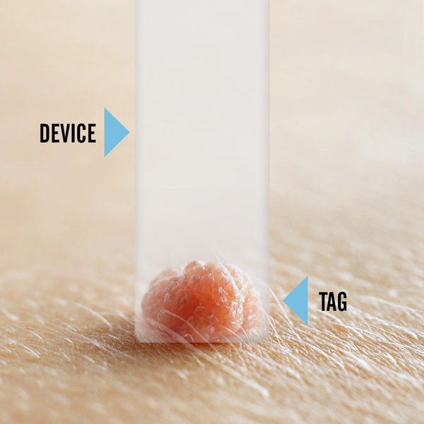 Tagcure PLUS - Skin Tag Removal Device 2