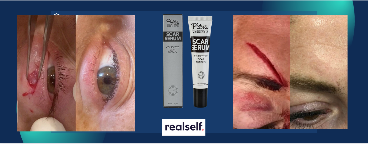 SCAR GEL FOR SURGICAL SCARS