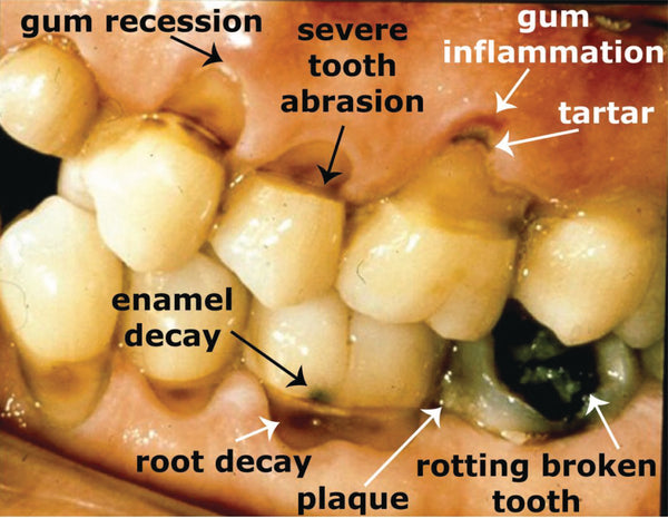 Typical damage from improper oral hgiene
