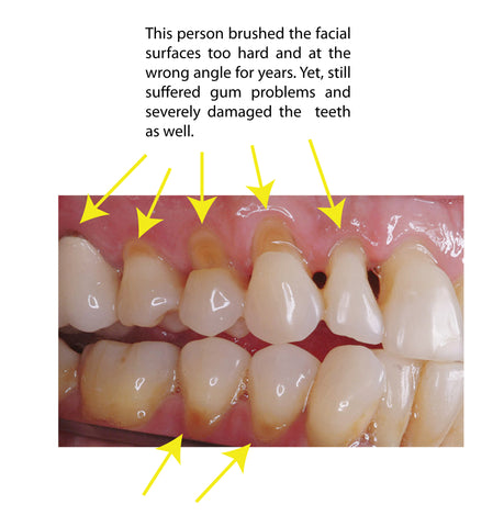 tooth abrasion and gum recession