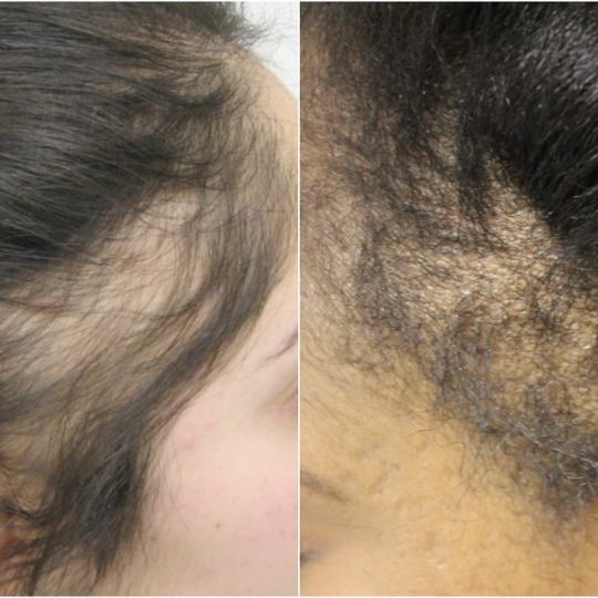 Beat traction alopecia with proper care