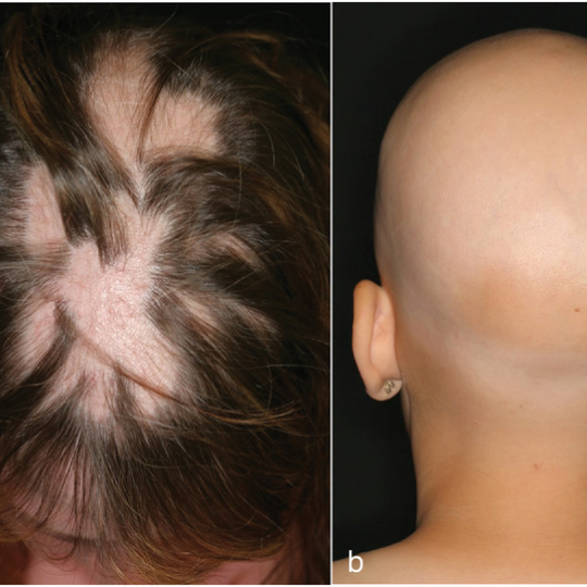 Types of alopecia areata 