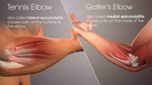 difference between tennis and golfers elbow
