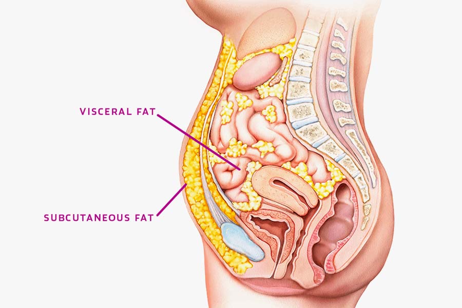 visceral vs subcutaneous fat