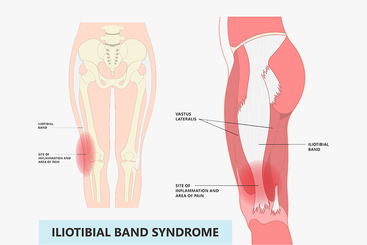 7 IT Band Stuff ideas  it band, hip flexor, it band stretches