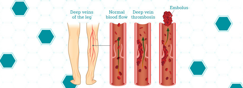 DVT Infographic