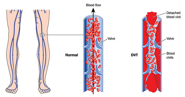 deep vein thrombosis leg