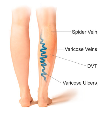 Varicose Veins