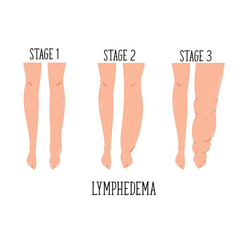lymphedema stages graphic