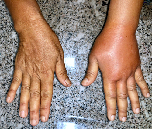 normal right hand vs left swollen hand