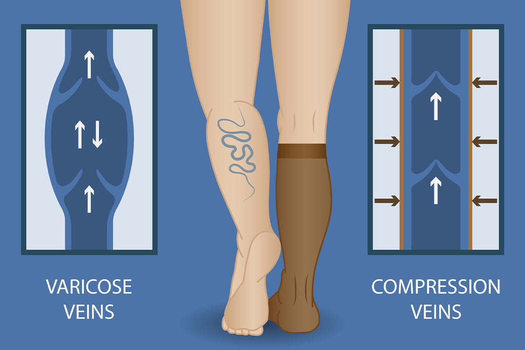 Plus Sized Compression Socks May Help Blood Flow In Obesity