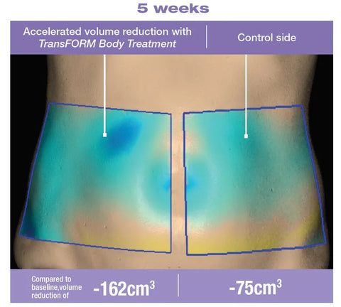 TransFORM Body Treatment Clinical Results