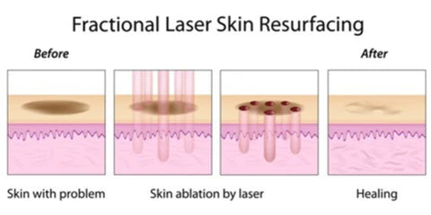 Fractional Laser Skin Resurfacing