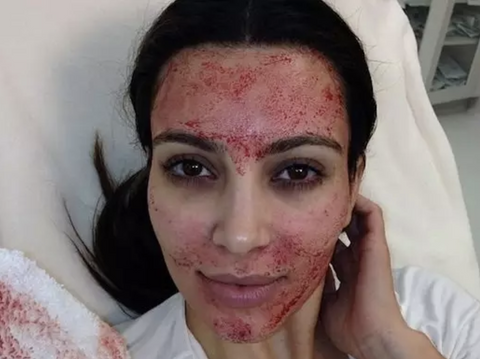 Kim Kardashian Vampire Facial Instagram Photo