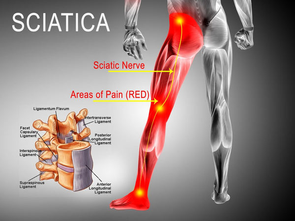 Treating Sciatica with a Massage Chair —