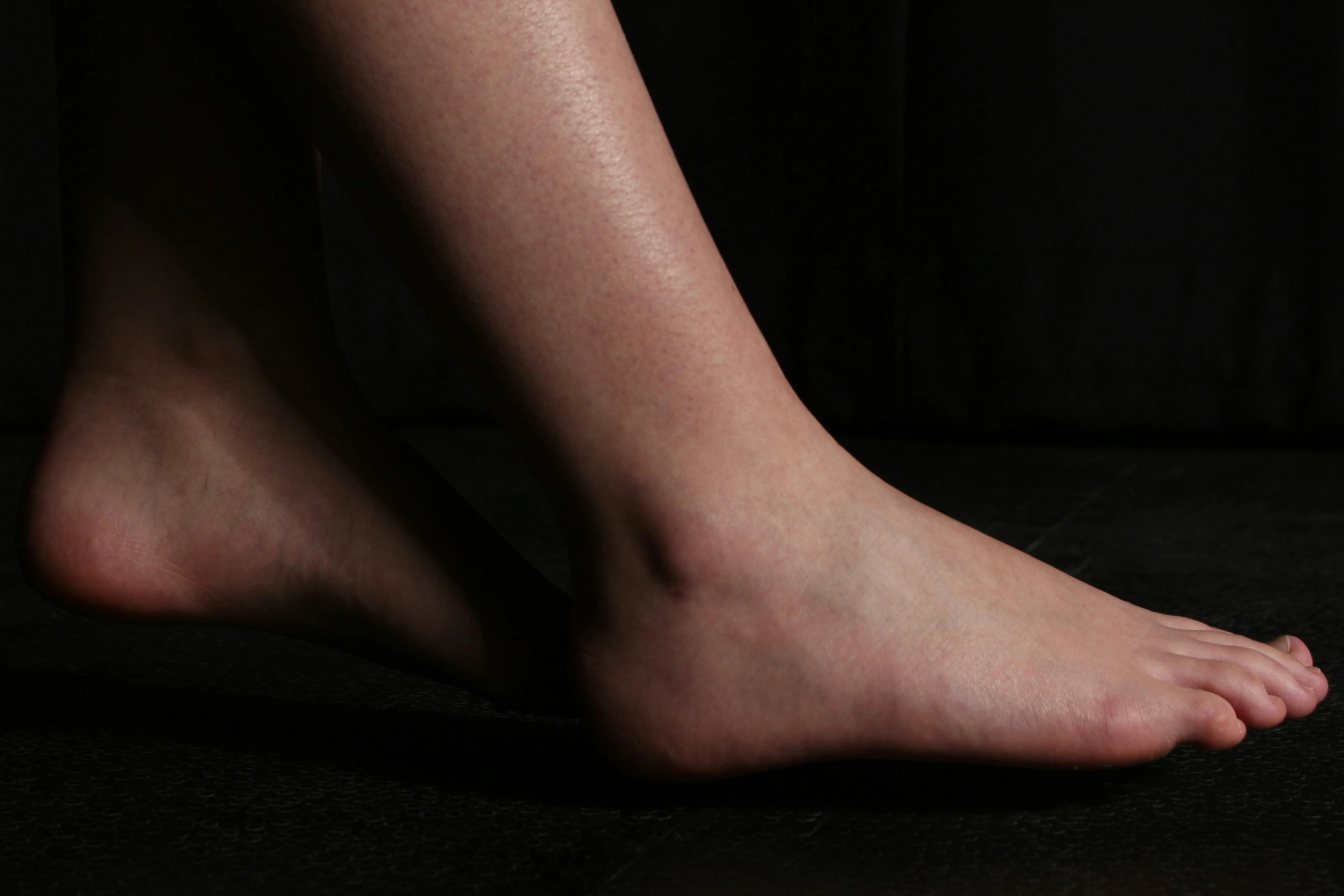 A Womans' leg having Postpartum Edema.