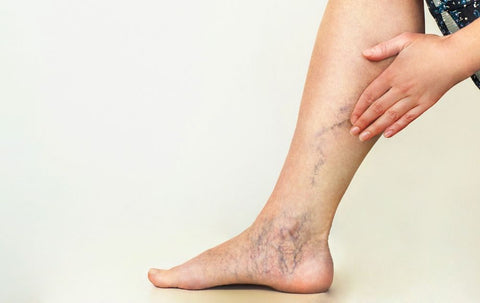 Compression Socks Prevent Leg Vein Problems