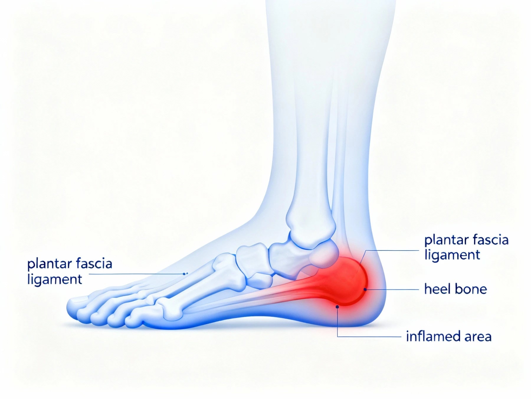 an illustration of how plantar fasciitis in one week.