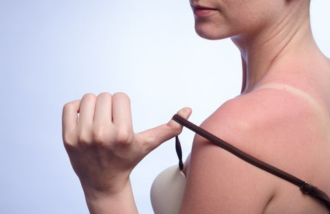 A woman's sunburned shoulders