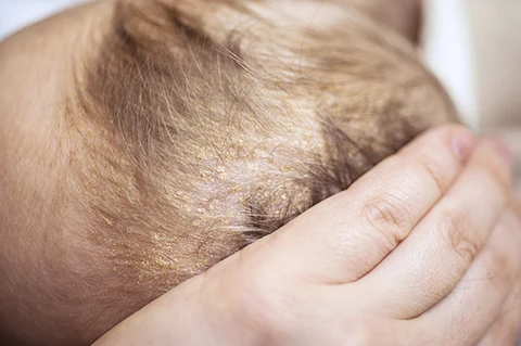 cradle cap on a baby's head