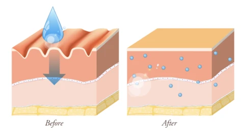 graphic showing the before and after of using hyaluronic acid