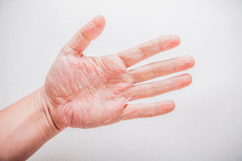 Eczema on palm of hands