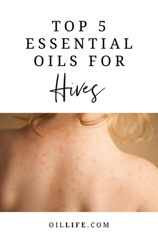 The Top 5 Best Essential Oils For Hives