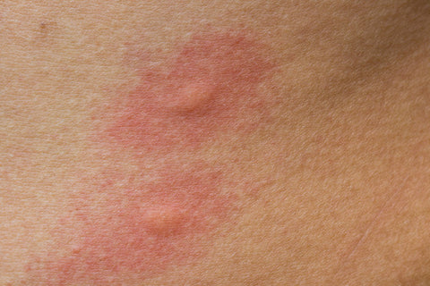 Psoriasis