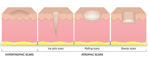 types of acne scarring