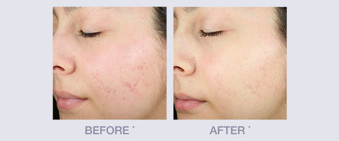 Avant et après de la gamme Anti Acne de Derma E
