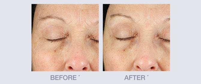 Before and After Anti-Wrinkle Line by Derma E