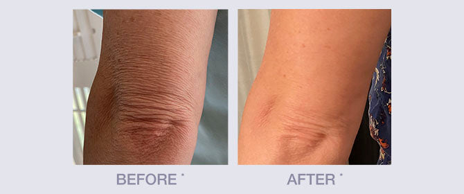 Before and After for Crepey Skin Repair Treatment and Exfoliating Pre-Treatment