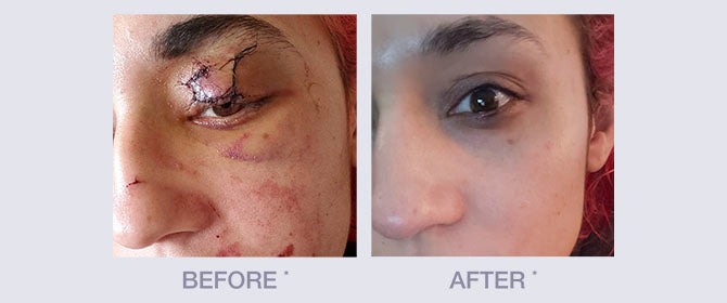 Before and After using Derma E Scar Gel