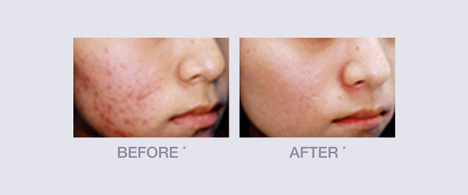 Before and After results for Vitamin C Serum