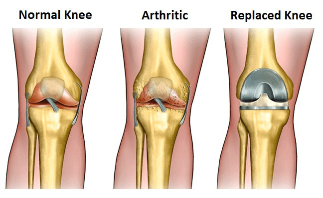 knee replacement 