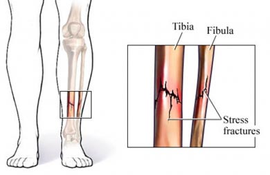 stress fracture, injuries