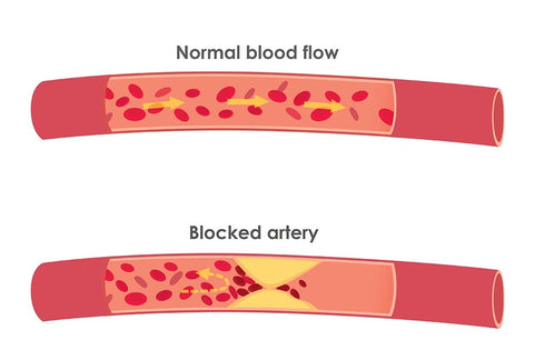 Cholesterol in Blood: Normal versus Blocked Artery