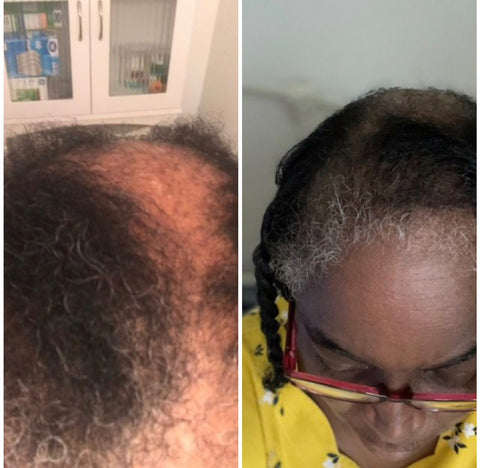 Tree Naturals Hair Growth Oil Results
