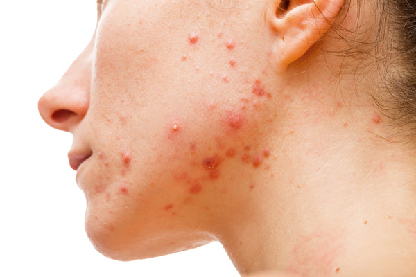 Young woman with acne, one of the signs that weight gain is caused by hormonal imbalance