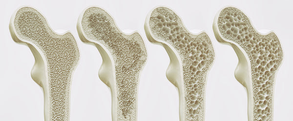 4 bones next to each other showing the diffence between having osteosporosis and not having it, one of the main benefits of taking diatomaceus earth.