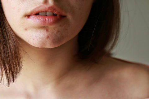 woman with hormonal acne on her chin
