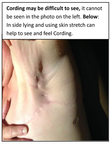 Cording After Breast Surgery: What It Is, How to Treat It