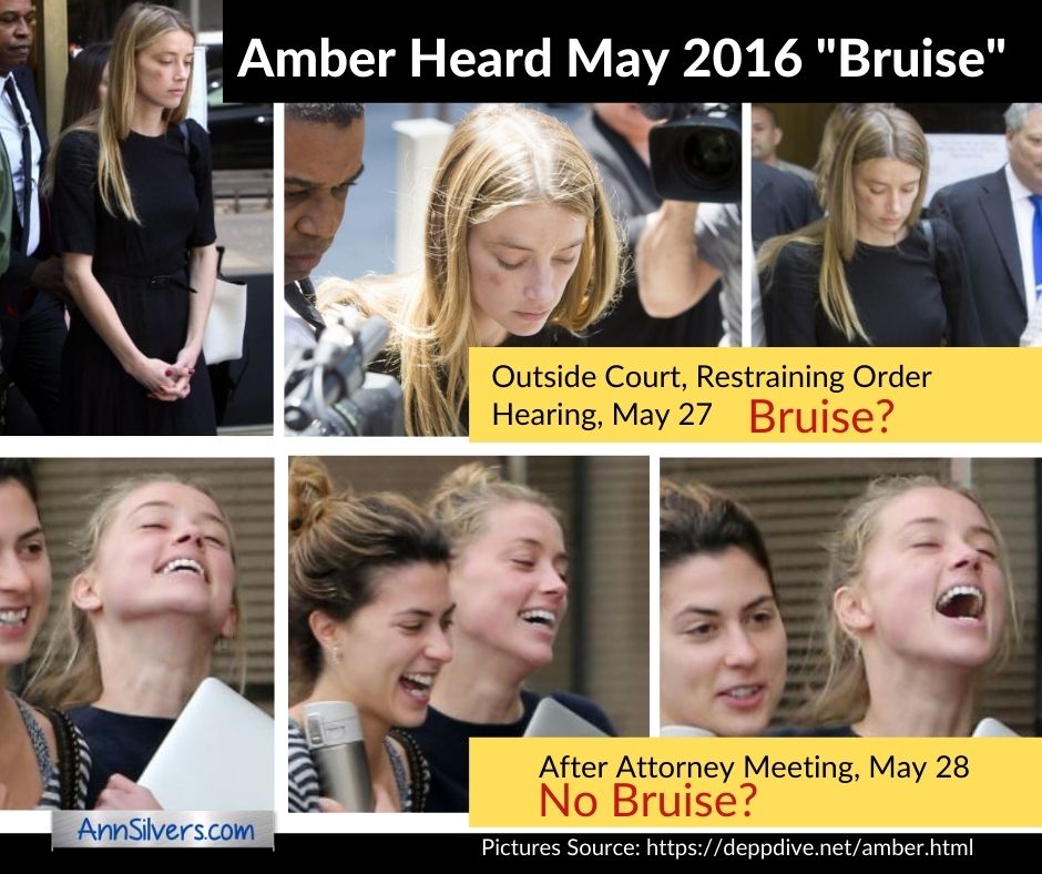 Amber Heard pictures of bruise May 2016