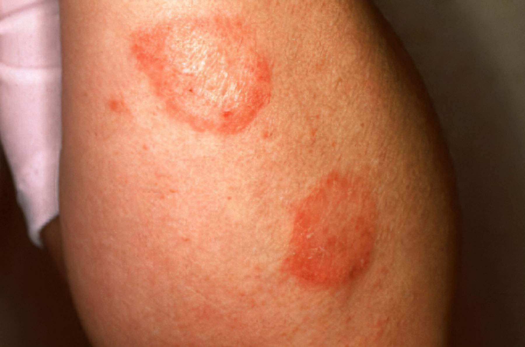 Chromium skin rash