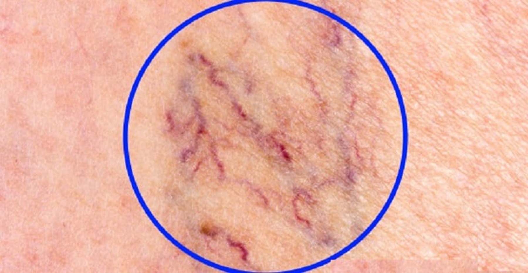 Human Varicose Veins