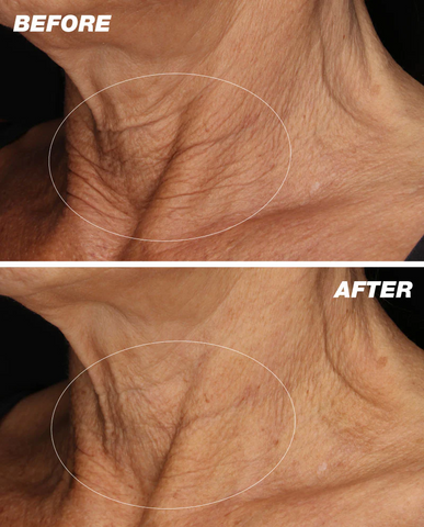 dermalogica-neck-fit-contour-serum-50-ml-before-and-after-results