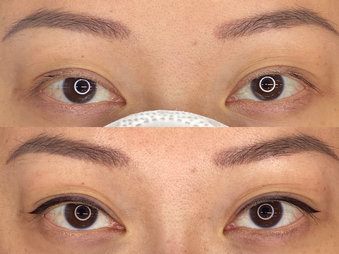 Mini Eyeliner Procedure Before and After results