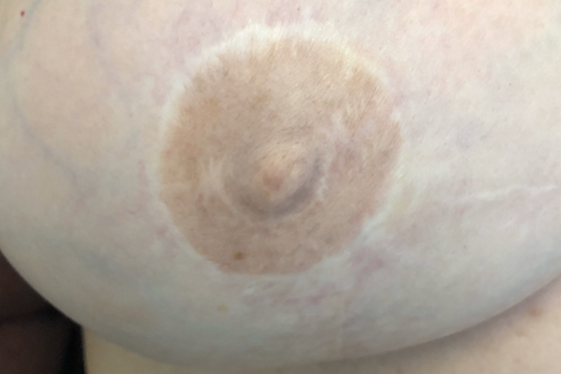 Areola Tattoo Picture Before by Jill Hoyer