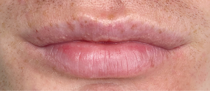 Case Study Male Lips Before Procedure